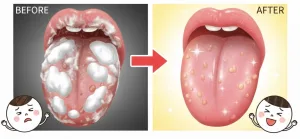 舌の表面に付着した白い舌苔と、それが除去されてきれいになった舌を比較したイラスト。味覚改善のイメージ。